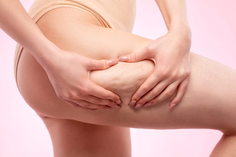 Une personne qui pince la peau de sa cuisse, laissant apparaître des traces de cellulite. Routine bien-être pour profiter des bienfaits du sauna sur la cellulite.